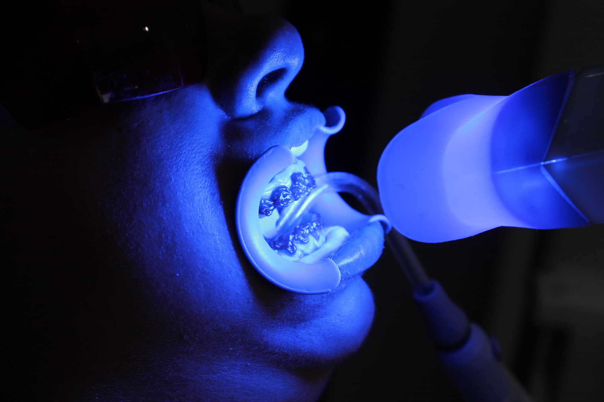 Teeth Whitening - İşman Dental Alanya