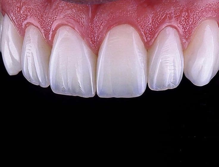 Fillings and Restorations - İşman Dental Alanya