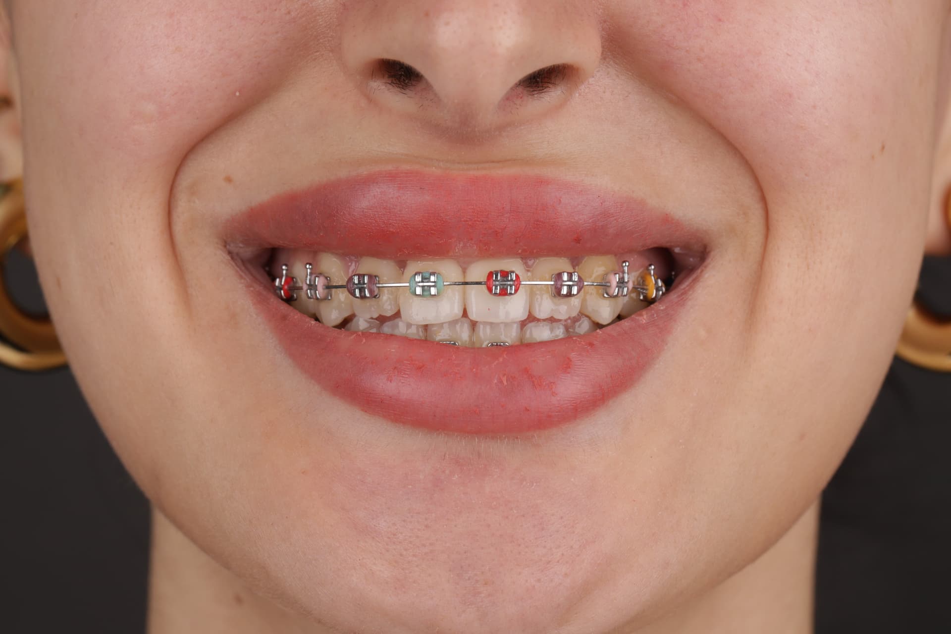 Orthodontic Treatment