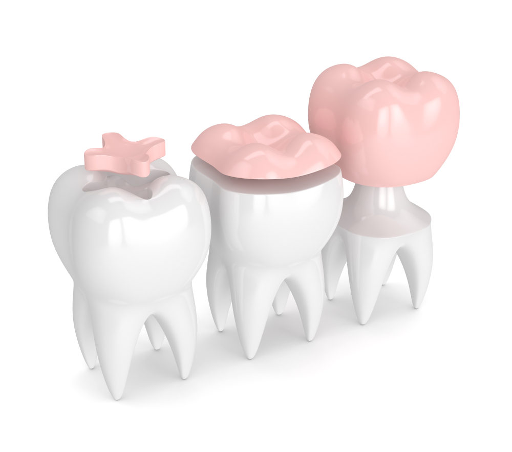 https://ismandental.com/wp-content/uploads/2022/02/Composite-Fillings-Prices.jpg