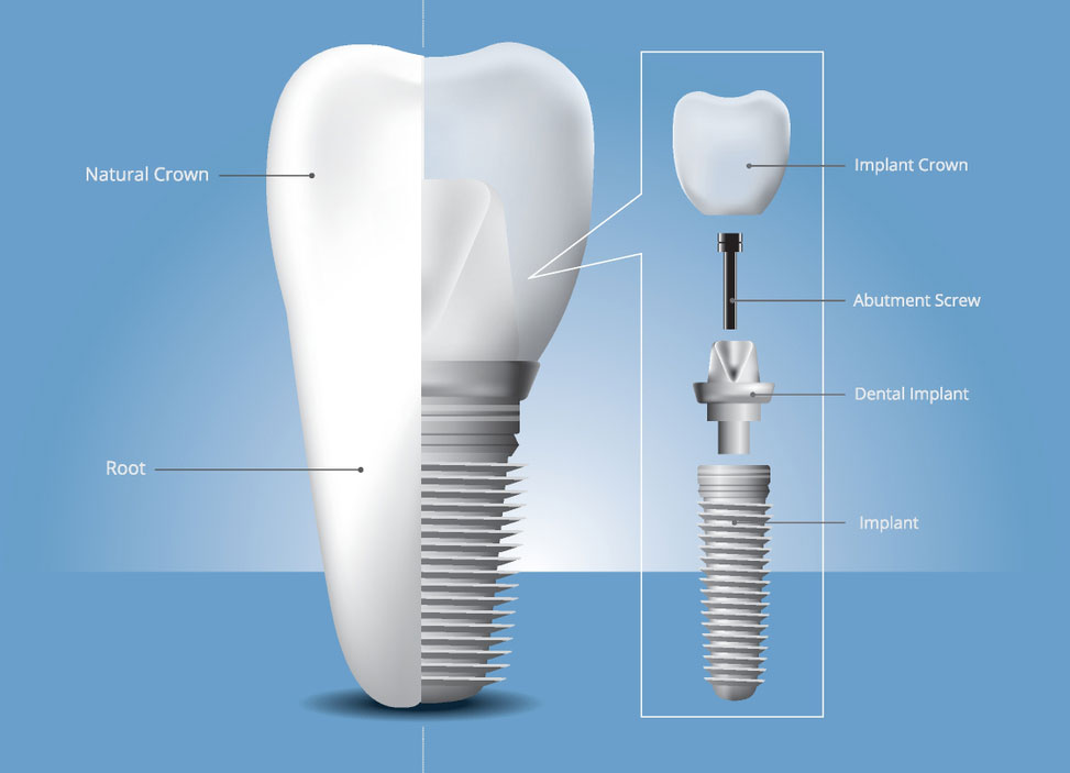 https://ismandental.com/wp-content/uploads/2022/03/Dental-Implant-Abutment.jpg