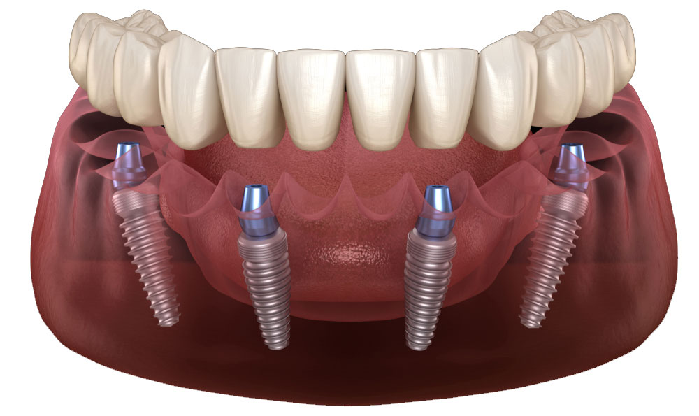 https://ismandental.com/wp-content/uploads/2022/03/Dental-Implant-All-On-Four.jpg